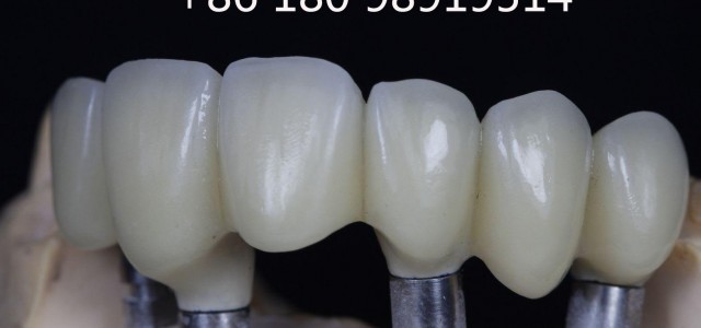 全口义齿 局部可摘义齿 3D 打印/设计 钴铬合金种植上部冠